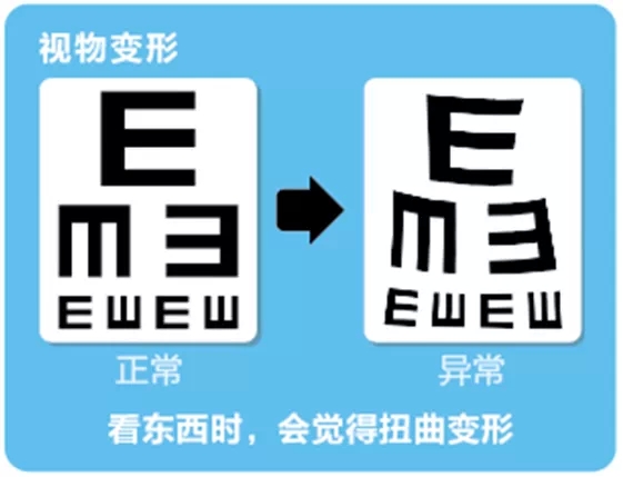 視網(wǎng)膜脫離啥癥狀？這張圖告訴你！