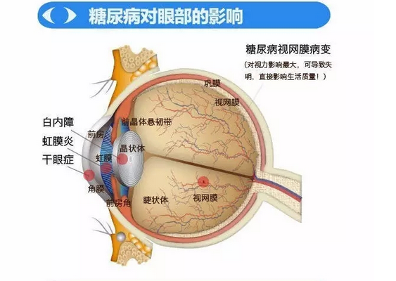 你造嗎？糖尿病晚期眼睛會致盲！