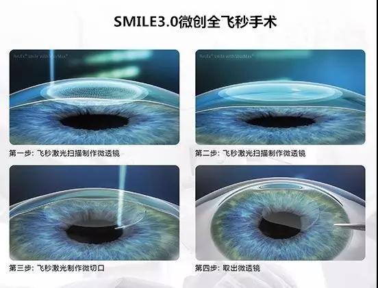 全國SMILE 之星手術視頻秀決賽 武漢普瑞眼科躋身前五