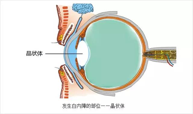 眼科主任告誡白內(nèi)障這幾大誤區(qū)，80%的老人上當(dāng)