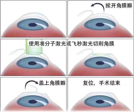 如果眼睛近視了該怎么？